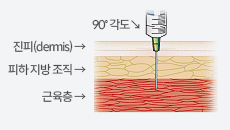 근육주사는 주사기를 90˚ 각도로 삽입해 진피(dermis)와 피하 지방 조직을 뚫고 근육층에 놓는 주사이다.